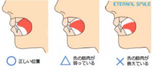 食いしばりと努力と石山【大阪市都島区内の歯医者|アスヒカル歯科】