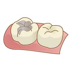 口の中のアマルガム・水銀の詰め物についてPart2【大阪市都島区内の歯医者|アスヒカル歯科】