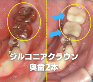 奥歯２本にセラミッククラウンをした症例