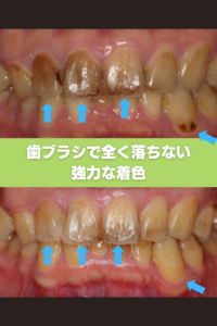 コーヒーの強力な着色をエアフローで除去