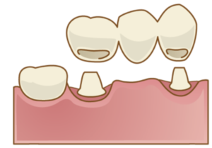 ブリッジと入れ歯選択のポイントと注意事項を紹介