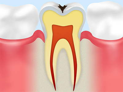 C2 象牙質のむし歯