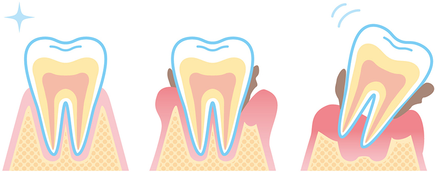 歯周病によるリスク