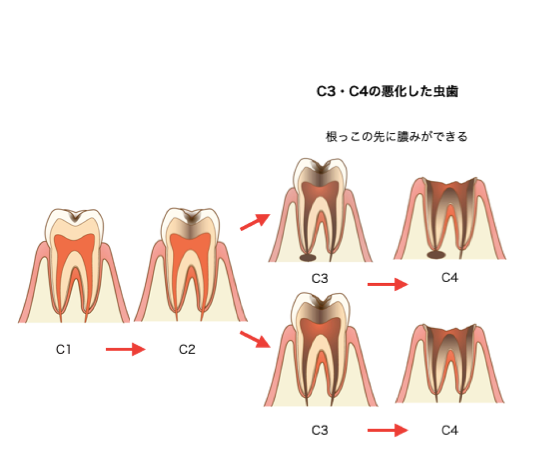 虫歯レベルの画像