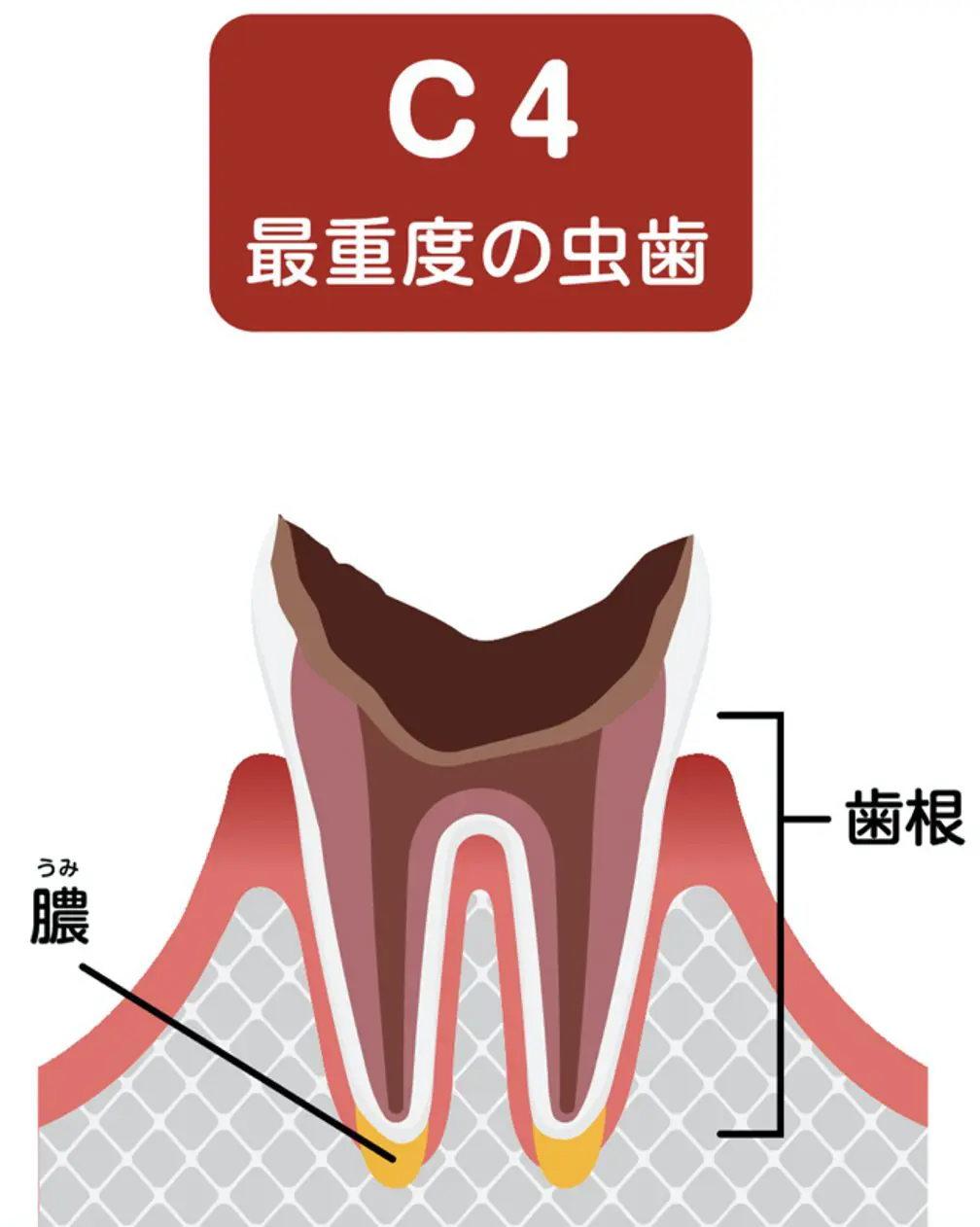 必見 あなたの歯は残せる 歯を抜かない治療とは