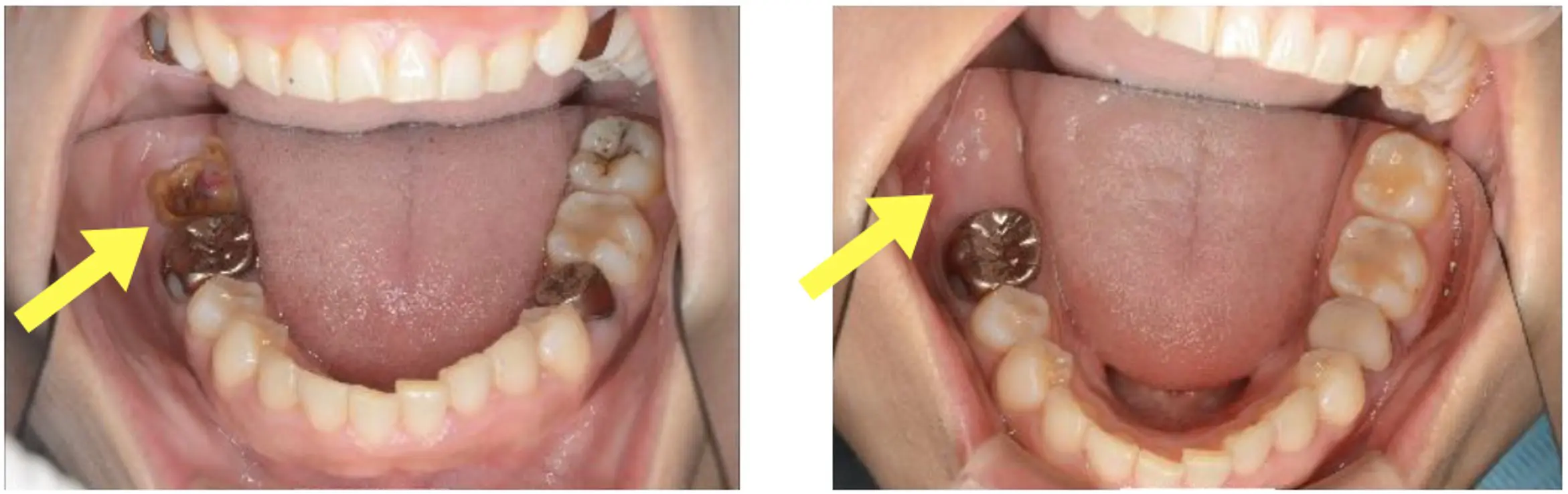 治療画像付き この虫歯はひどい状態 今後の治療の流れを解説