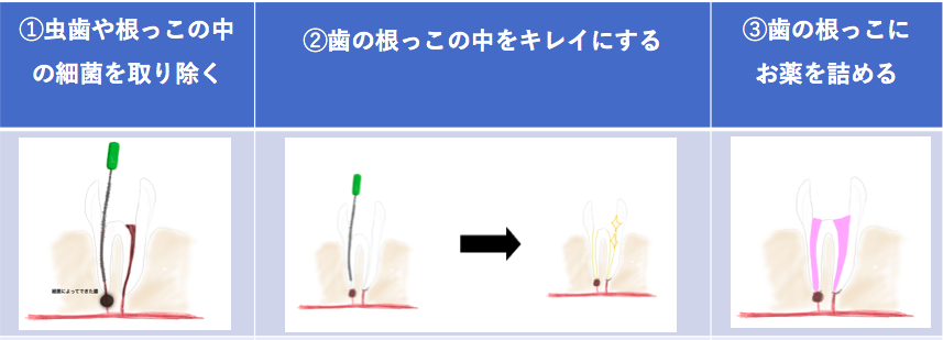 根管治療を受けて今まさに痛いあなたへ 今すぐ可能な痛みの緩和方法