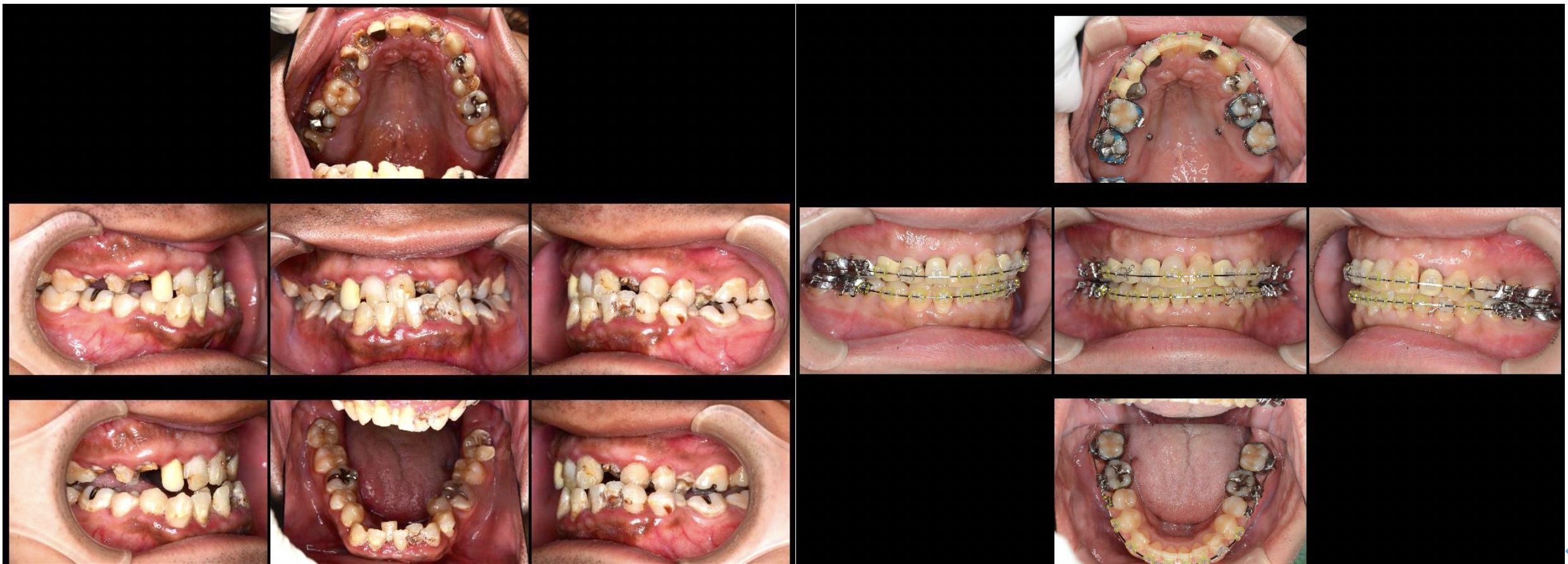 ひどい虫歯の治療
