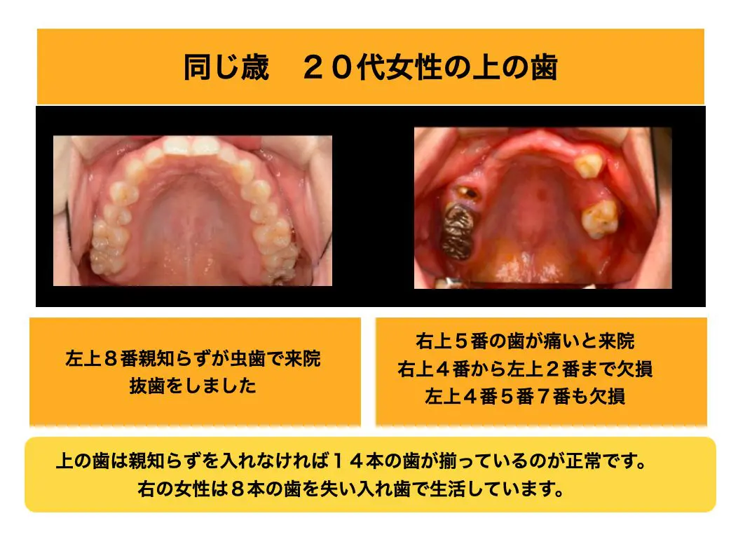 放置をすると２０代でも入れ歯になる 虫歯だらけのリスクとそれを回避する方法