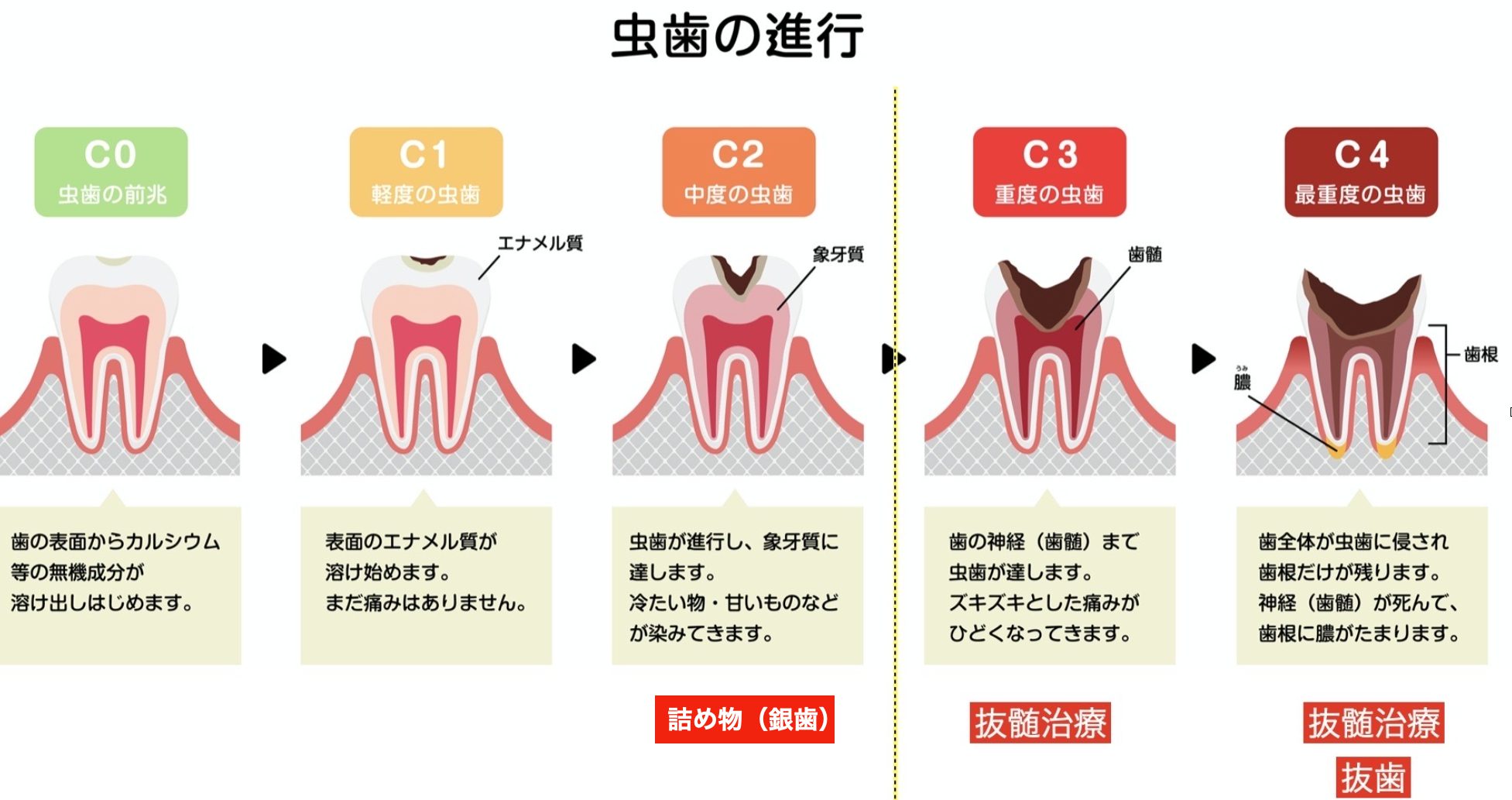 虫歯の進行の画像