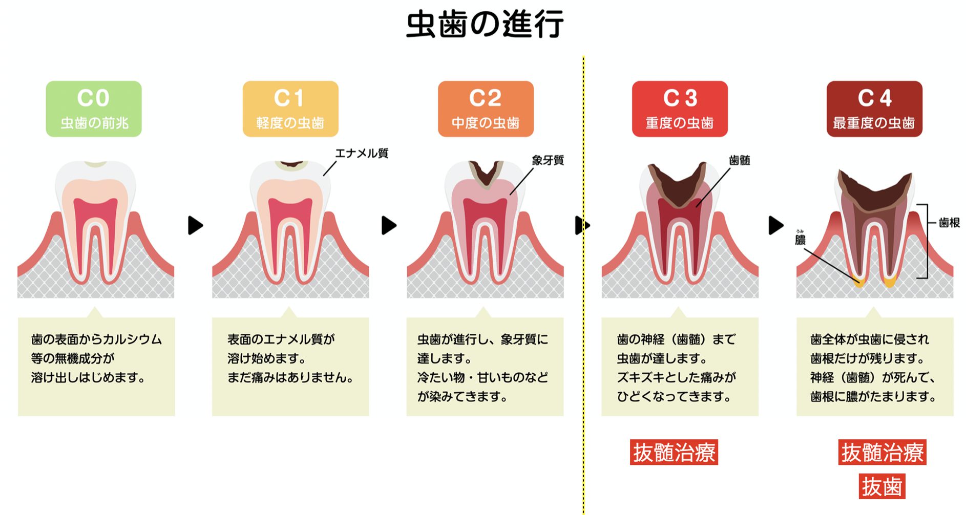 虫歯　重症度