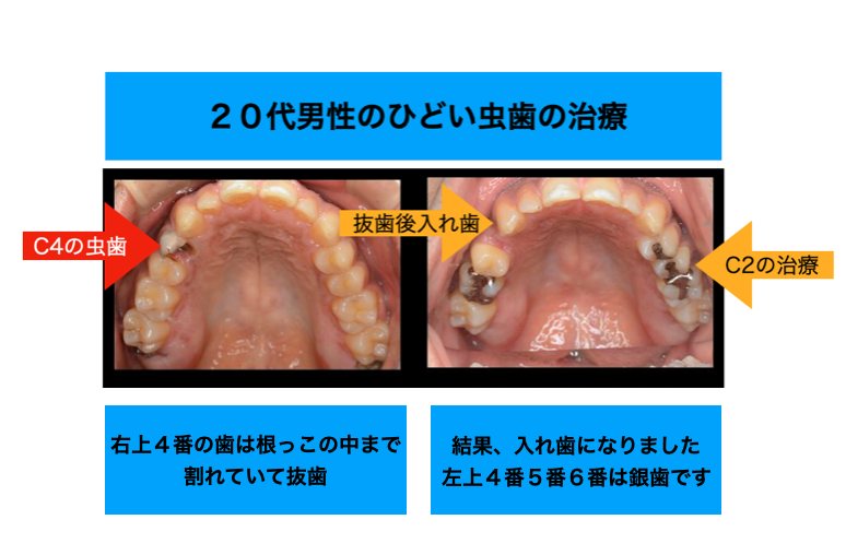２０代男性ひどい虫歯の症例２