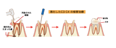 悪化したC3C4の虫歯
