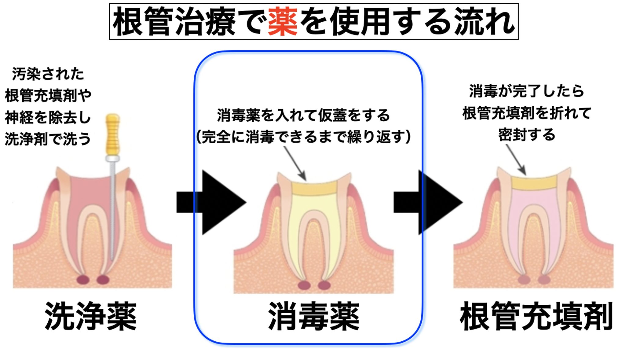 根管が失敗する可能性はありますか?