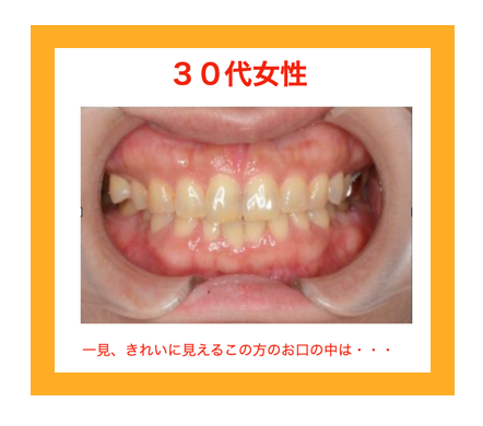 ３０代女性虫歯