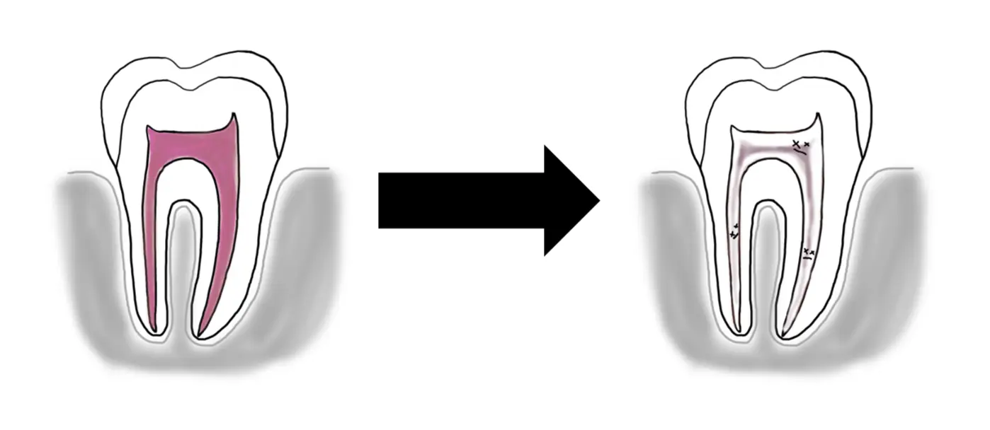 放置すると抜歯になる 専門医が解説する歯の神経が腐る原因と治療法
