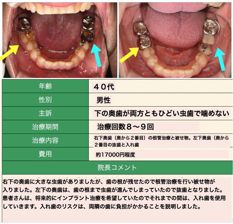 虫歯症例１