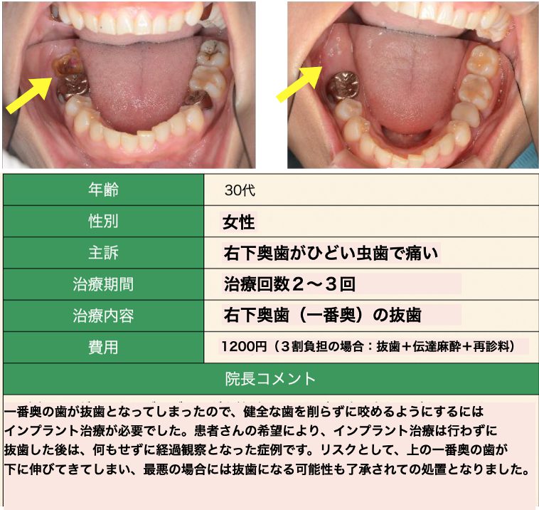 虫歯症例２