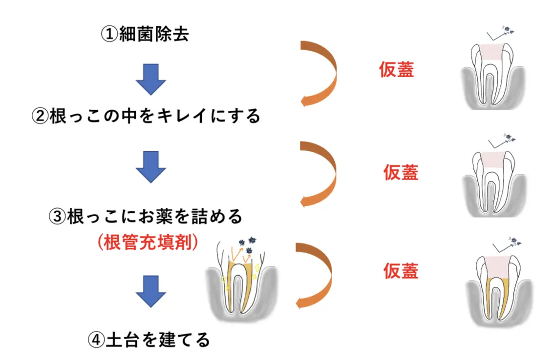 詰め物で成功が決まる 根管治療の詰め物を根管治療専門医が徹底解説