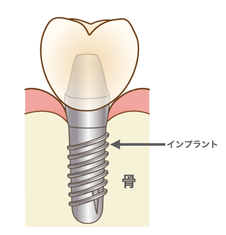 安心して治療を受けるために インプラントのメリット デメリット