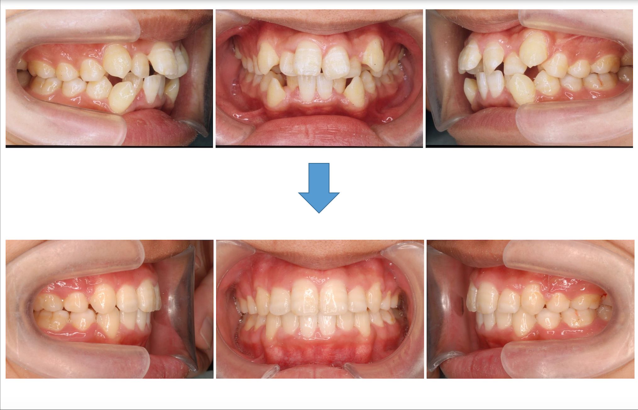 諦めないで 気になる八重歯を矯正治療