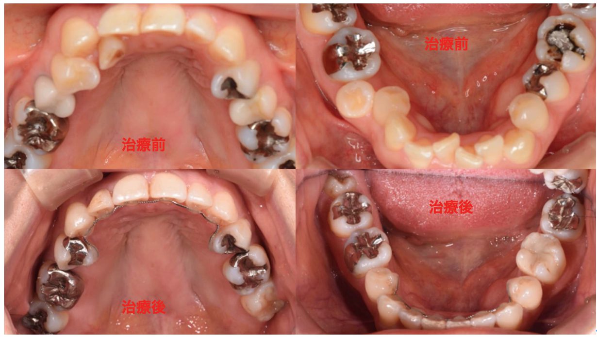 歯列矯正症例写真２