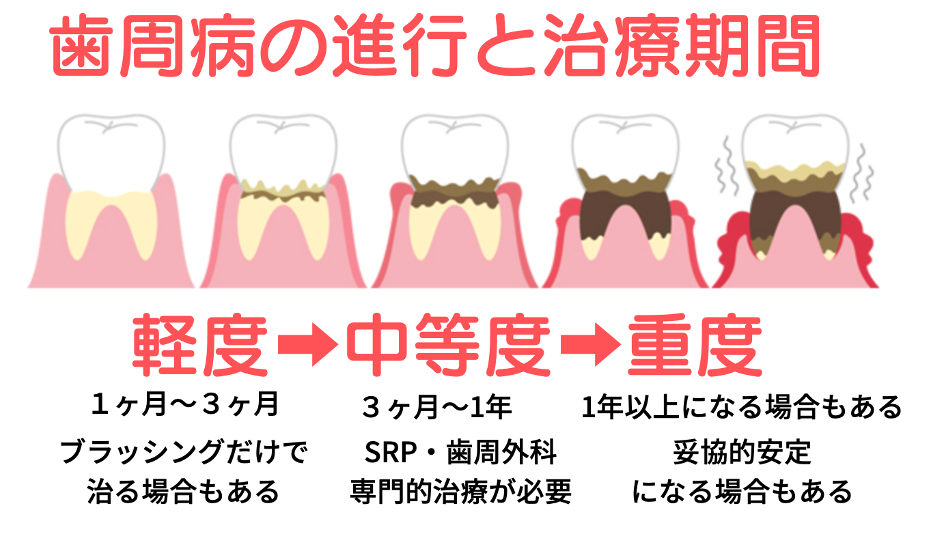必見!知りたい歯周病治療の治療期間!3段階の状態で徹底解説!