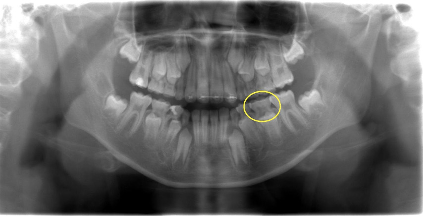 乳歯レントゲン