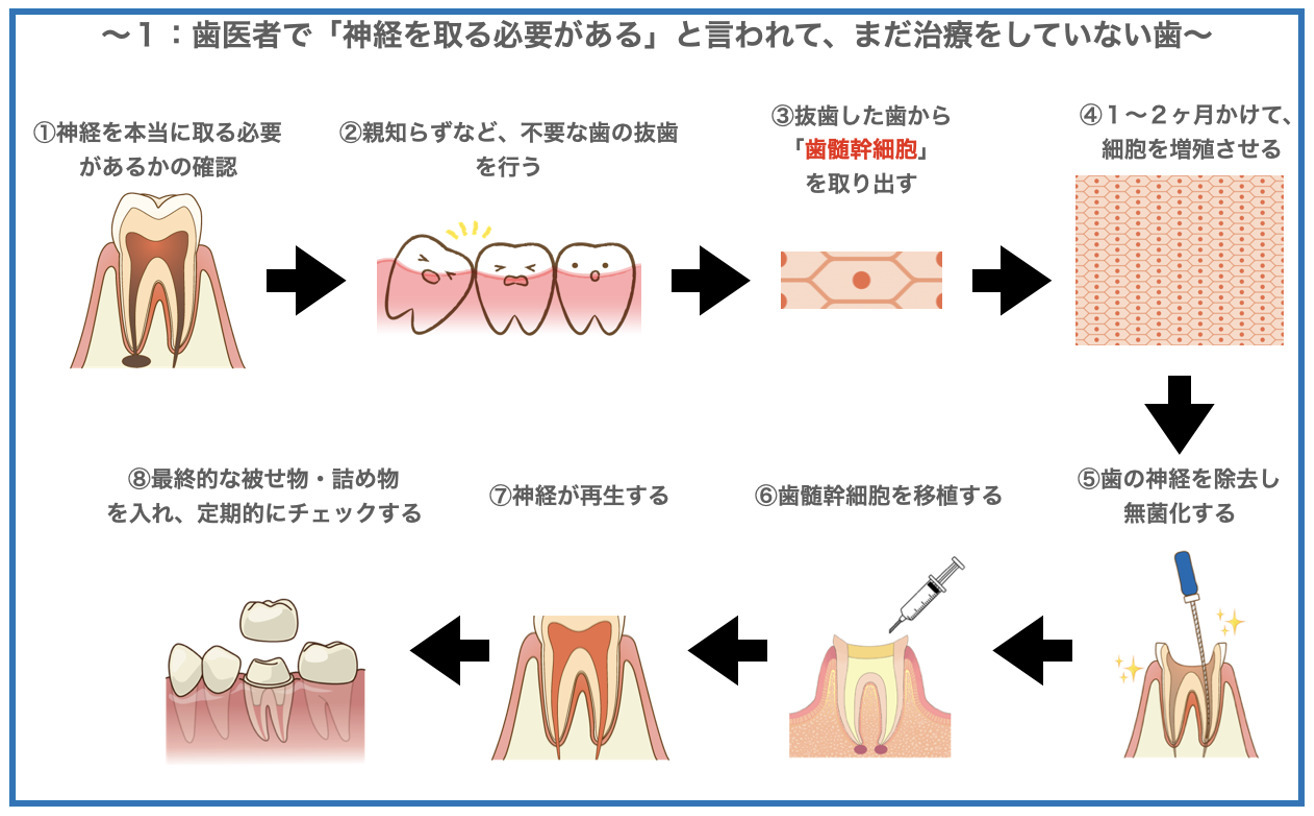 歯髄再生治療