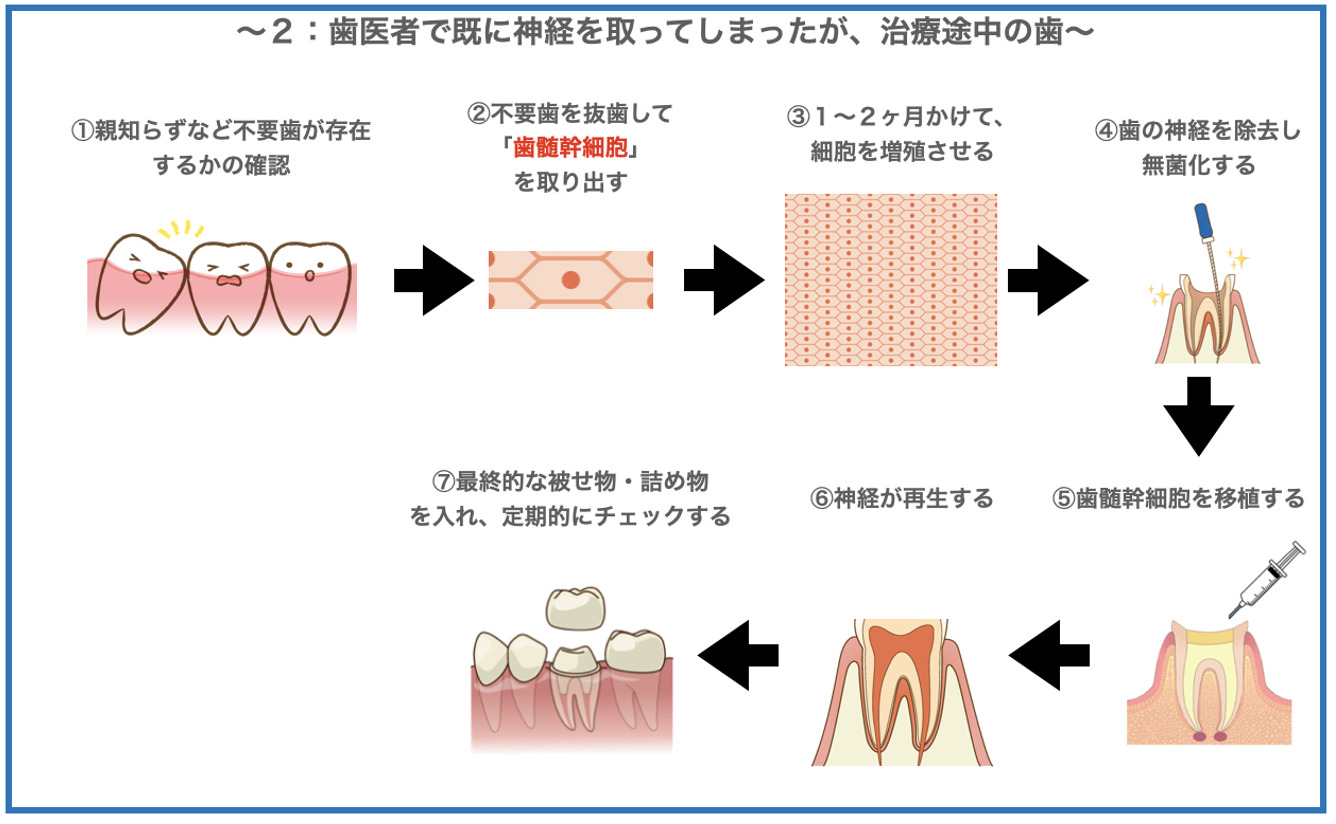 歯髄再生治療