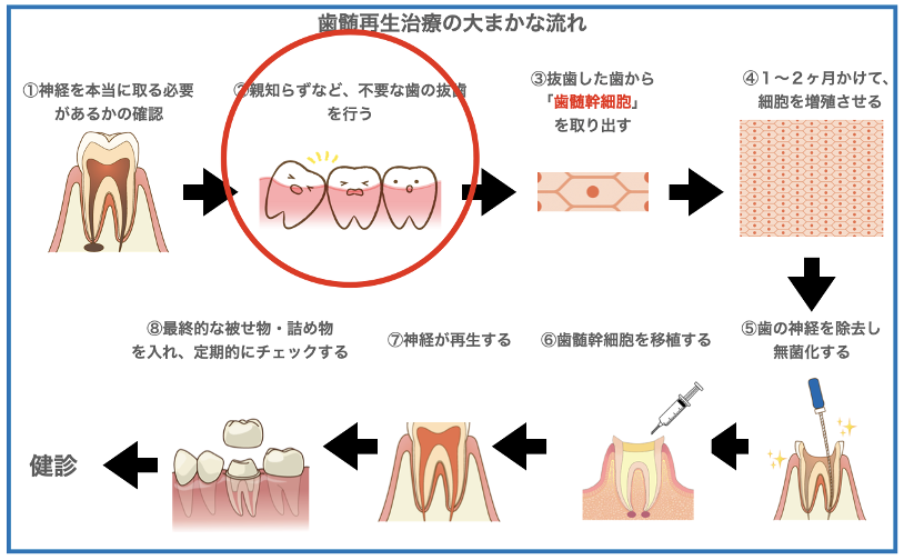 歯髄再生治療親知らず印