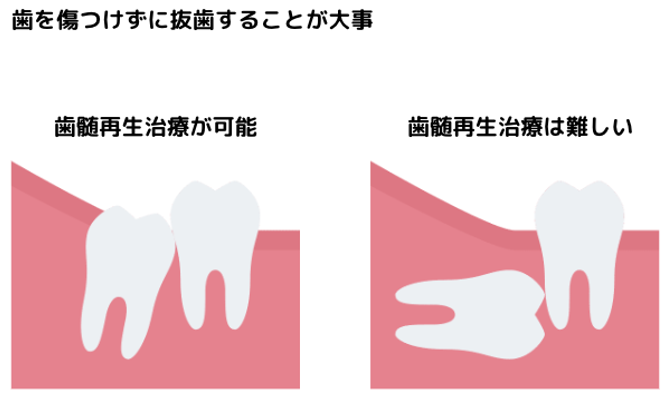 抜歯の基準