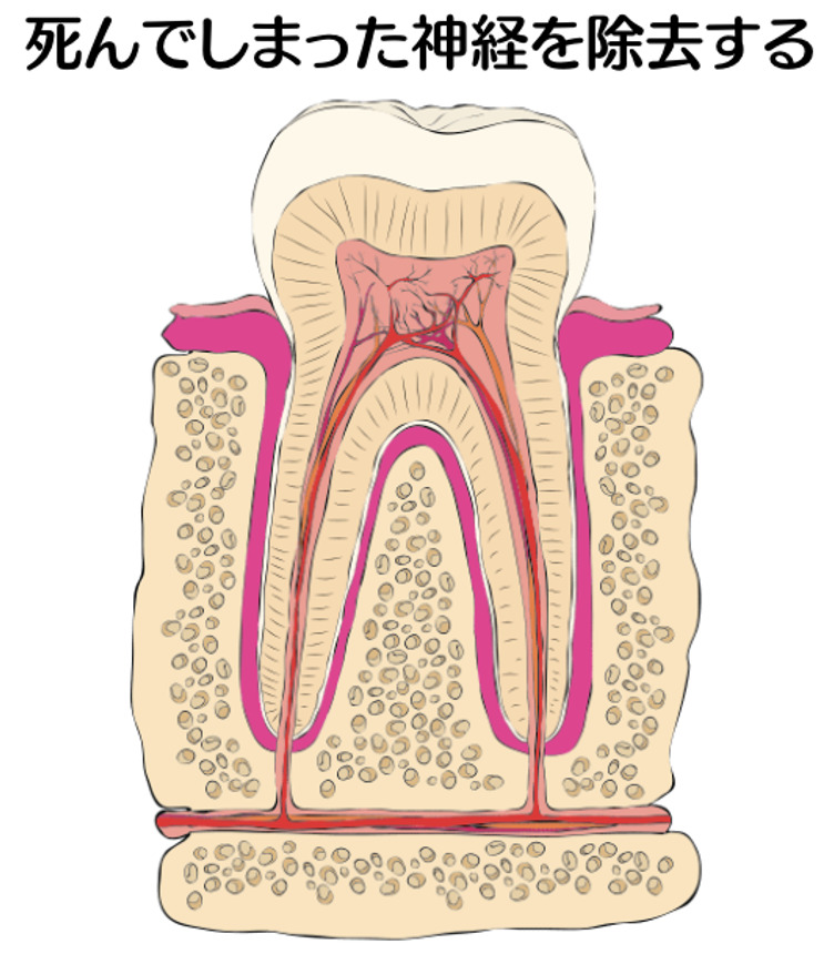 歯の神経イラスト